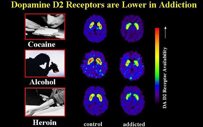 Comparison of brain scans showing lower dopamine D2 receptor availability in cocaine, alcohol, and heroin addiction versus control brains