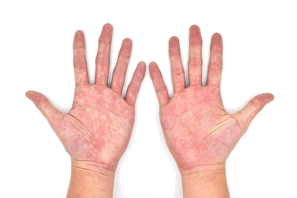 Close-up of two palms showing reddened, flushed appearance characteristic of palmar erythema, a potential sign of liver issues often associated with alcohol abuse