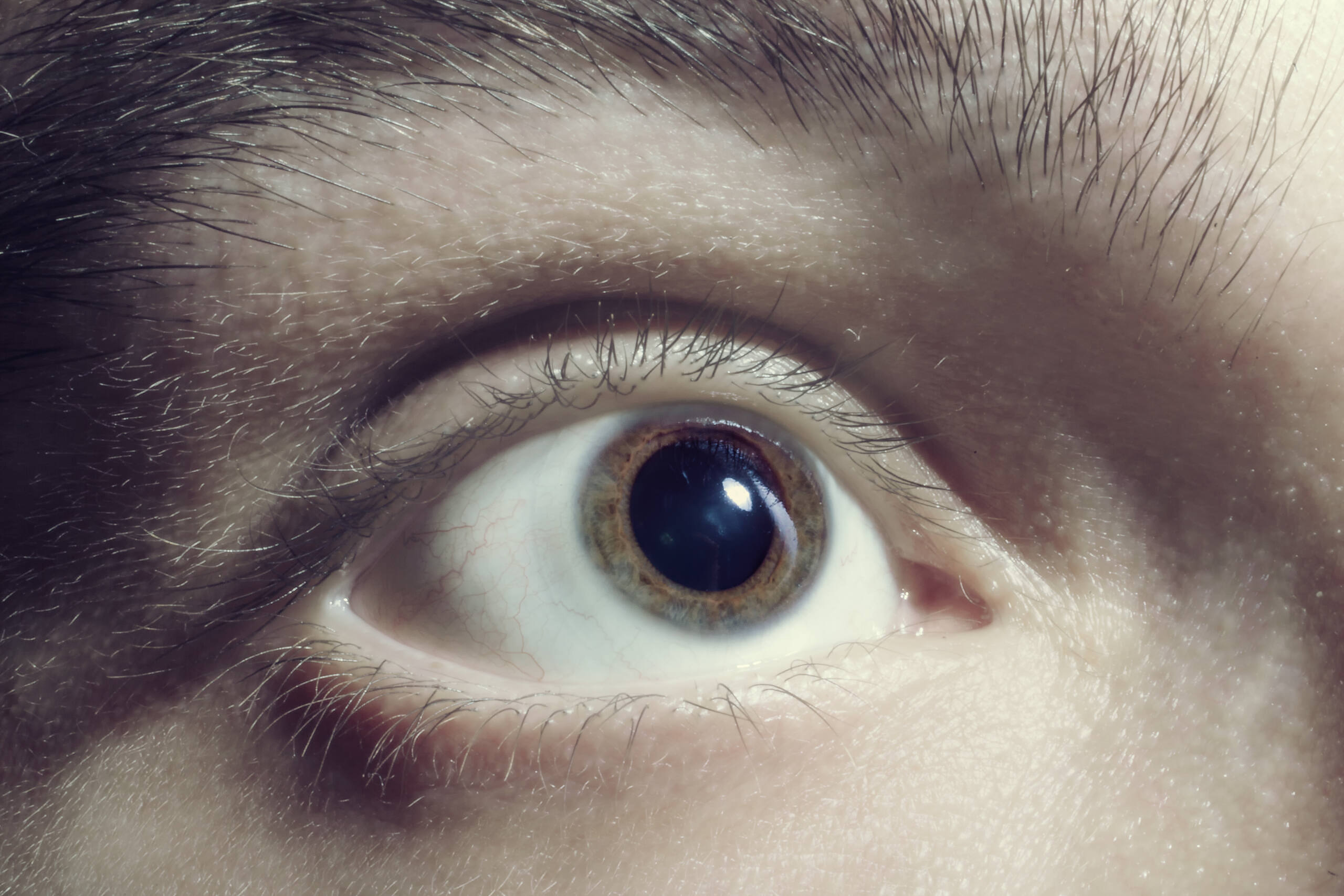 Close-up of a dilated human eye, showing effects of cocaine use on pupil size