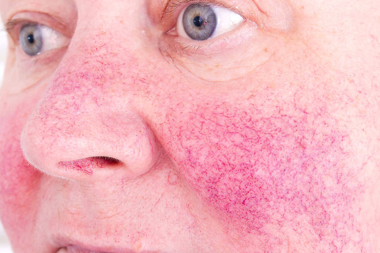 Close-up of a person's face showing reddened, flushed skin across the cheeks and nose, resembling rosacea, which can be exacerbated by alcohol consumption