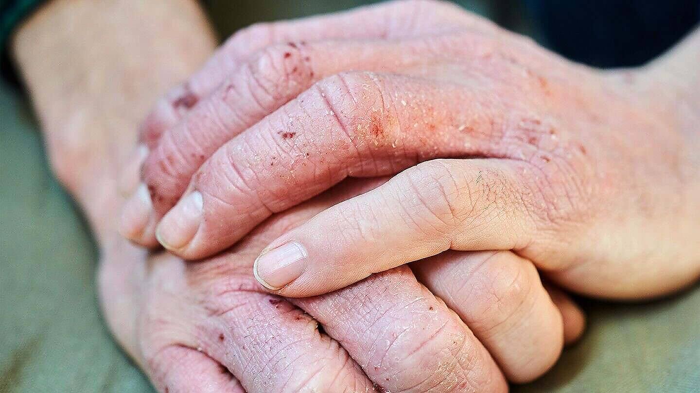 Close-up of clasped hands showing dry, reddened skin with possible eczema or dermatitis, which can be exacerbated by alcohol consumption