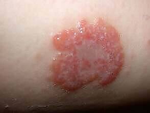 Close-up image of a red, patchy skin rash likely caused by alcohol consumption, showing inflamed and irritated skin