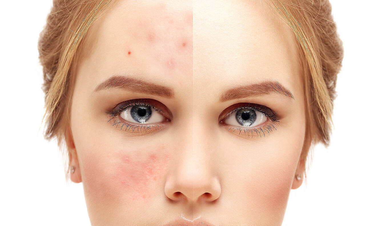 A close up view of a young woman's face. Showing two opposing images of her face. One with clear normal skin and the other with skin showing spots and pimples indicating alcohol-related skin reactions.