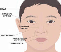 Child's face illustrating the features caused by Fetal Alcohol Spectrum Disorder