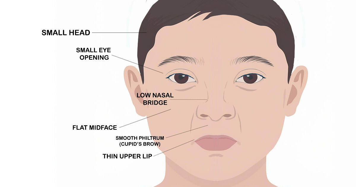 Child's face illustrating the features caused by Fetal Alcohol Spectrum Disorder