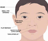 Illustration of a child's face showing characteristic features of Fetal Alcohol Syndrome, including small head, small eye opening, low nasal bridge, flat midface, smooth philtrum, and thin upper lip, with labels